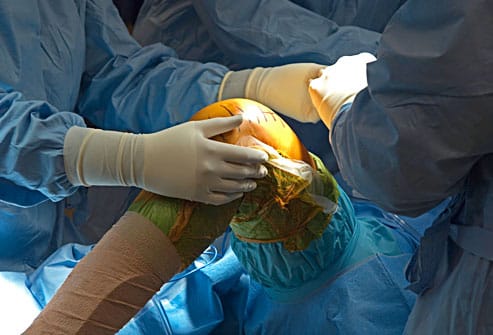 You are currently viewing Total Knee Replacement Surgery: Top Myths & Facts